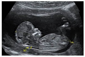 Image échographique d’un foetus  